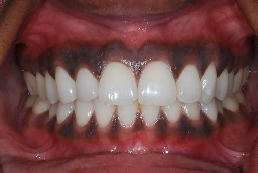 8 điều mà hàm răng nói về sức khoẻ của bạn - Ảnh 7